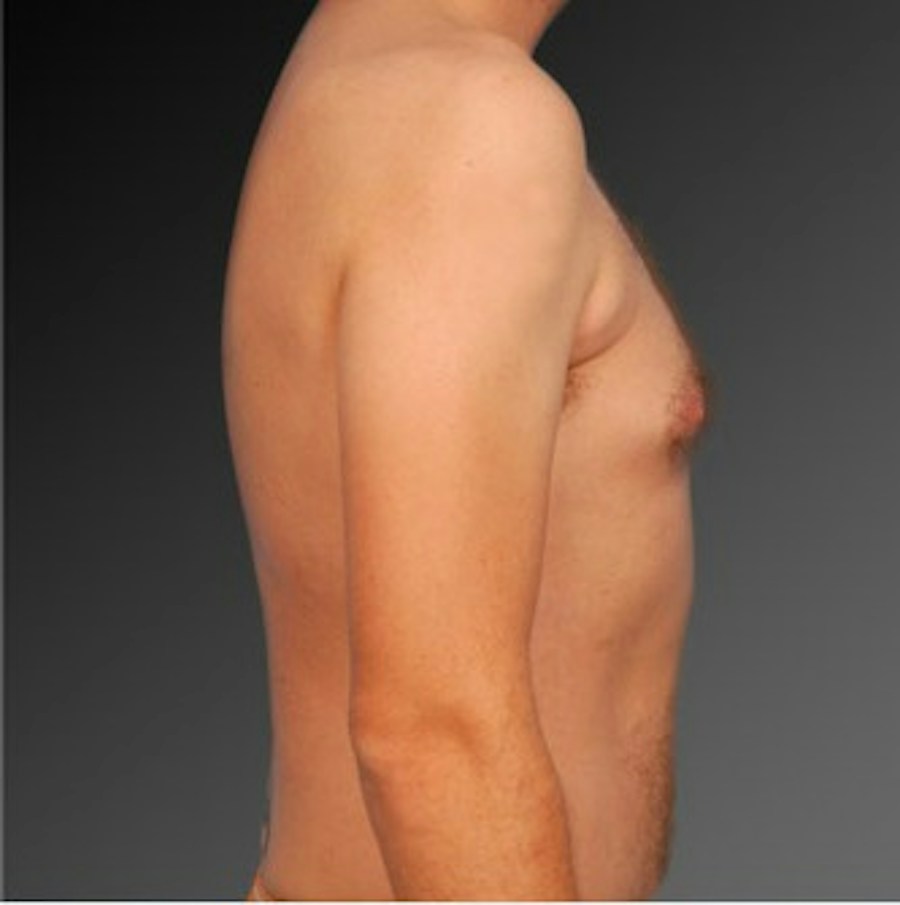Patient 106041459 | Profile View | Before | Chest (Gynecomastia) — Steven Teitelbaum MD -