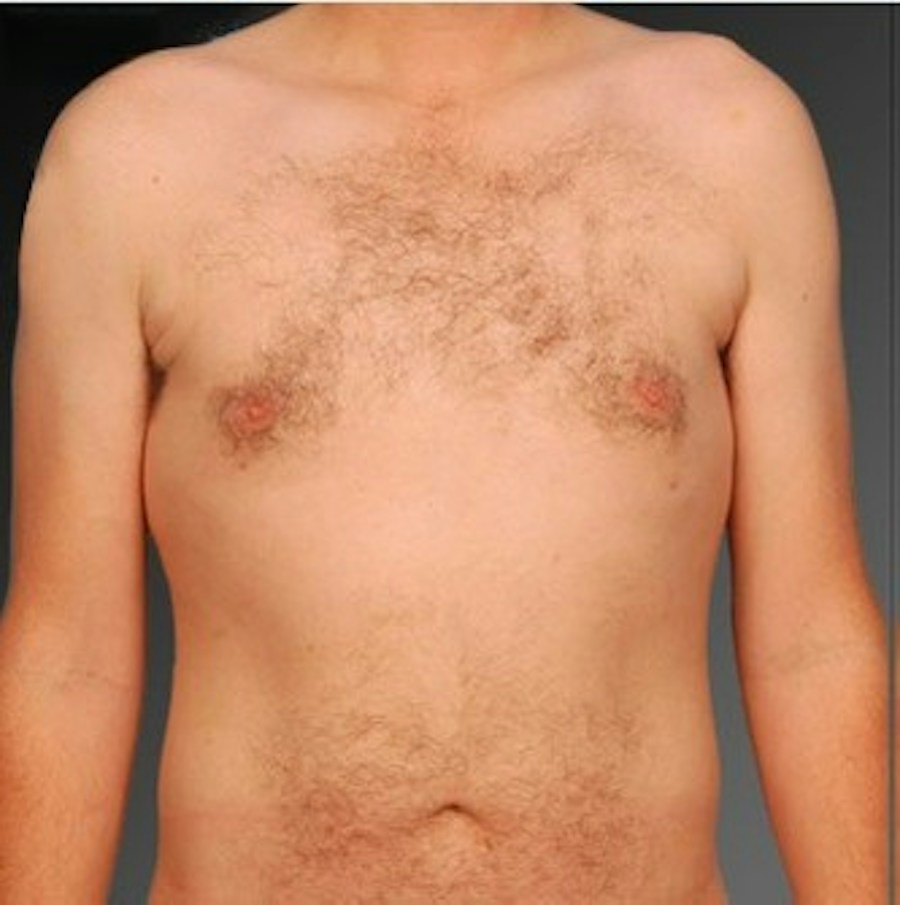 Patient 106041459 | Front View | After | Chest (Gynecomastia) — Steven Teitelbaum MD -