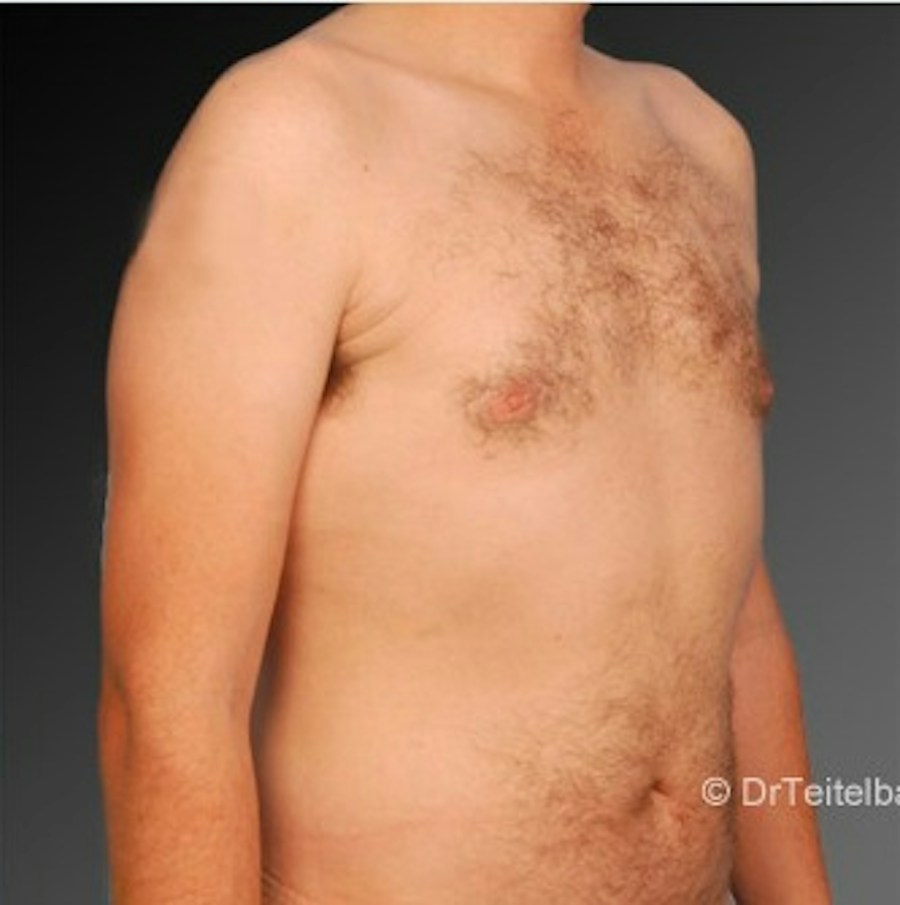 Patient 106041459 | Angle View | After | Chest (Gynecomastia) — Steven Teitelbaum MD -