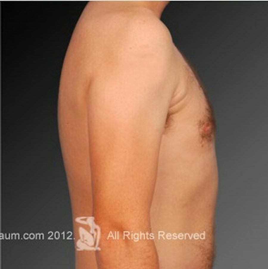 Patient 106041459 | Profile View | After | Chest (Gynecomastia) — Steven Teitelbaum MD -