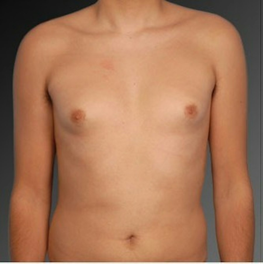Patient 106041460 | Front View | Before | Chest (Gynecomastia) — Steven Teitelbaum MD -
