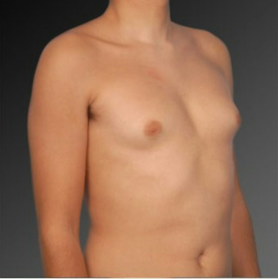 Patient 106041460 | Angle View | Before | Chest (Gynecomastia) — Steven Teitelbaum MD -