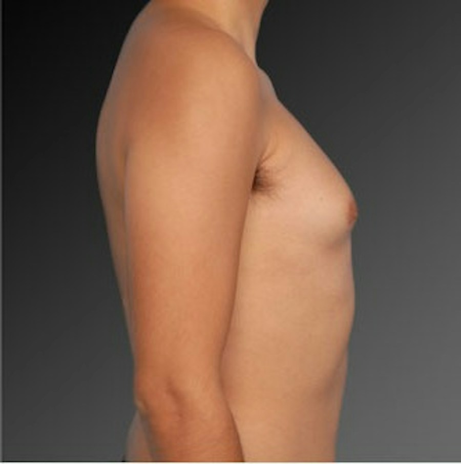 Patient 106041460 | Profile View | Before | Chest (Gynecomastia) — Steven Teitelbaum MD -