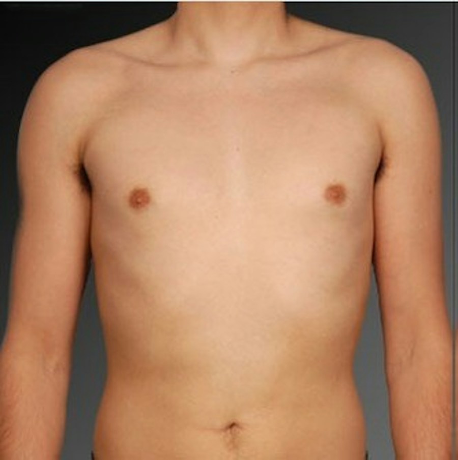 Patient 106041460 | Front View | After | Chest (Gynecomastia) — Steven Teitelbaum MD -