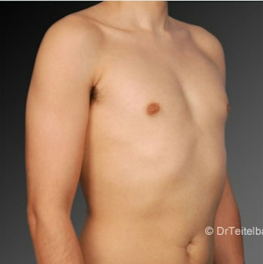 Patient 106041460 | Angle View | After | Chest (Gynecomastia) — Steven Teitelbaum MD -