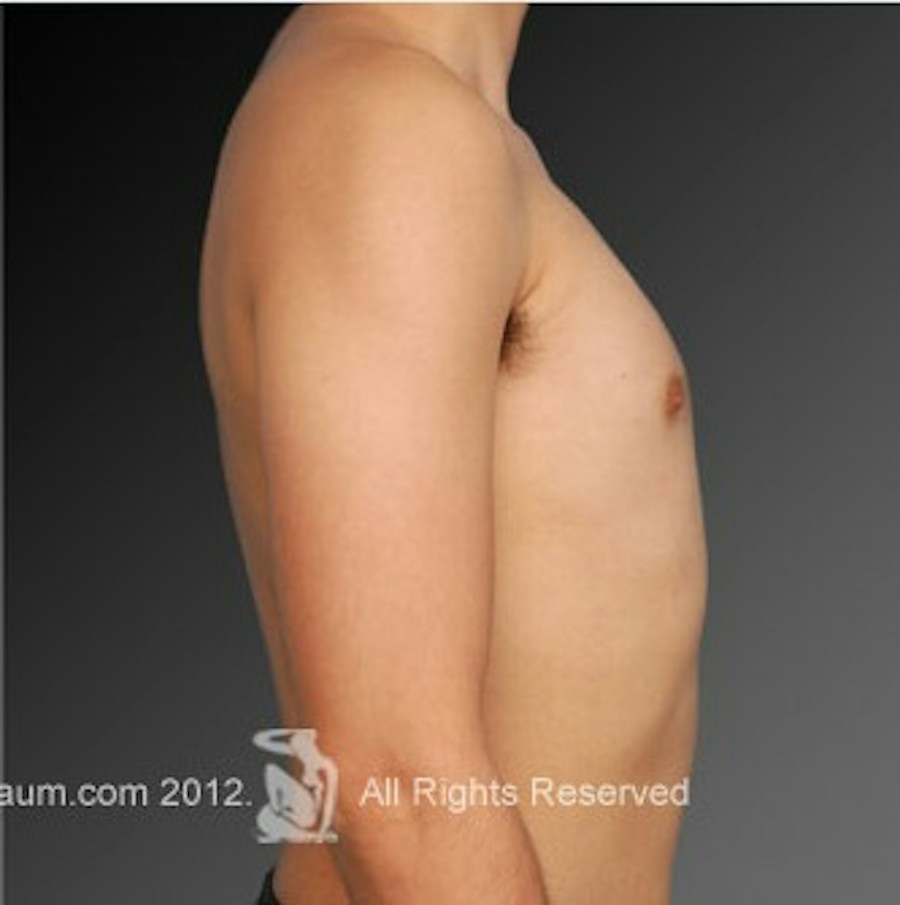 Patient 106041460 | Profile View | After | Chest (Gynecomastia) — Steven Teitelbaum MD -