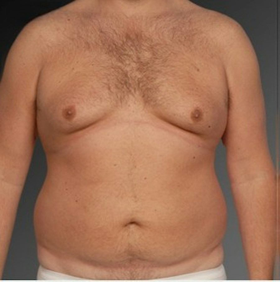 Patient 106041462 | Front View | Before | Chest (Gynecomastia) — Steven Teitelbaum MD -