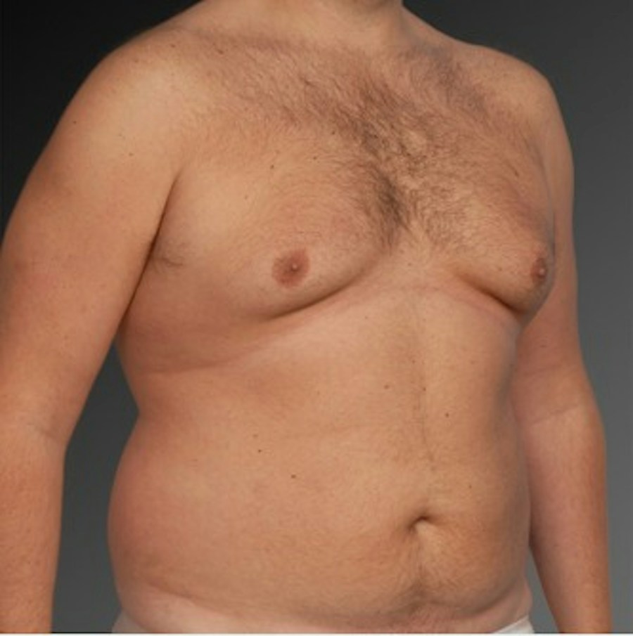 Patient 106041462 | Angle View | Before | Chest (Gynecomastia) — Steven Teitelbaum MD -