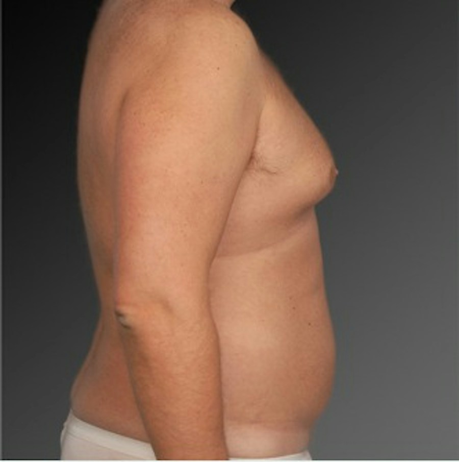 Patient 106041462 | Profile View | Before | Chest (Gynecomastia) — Steven Teitelbaum MD -