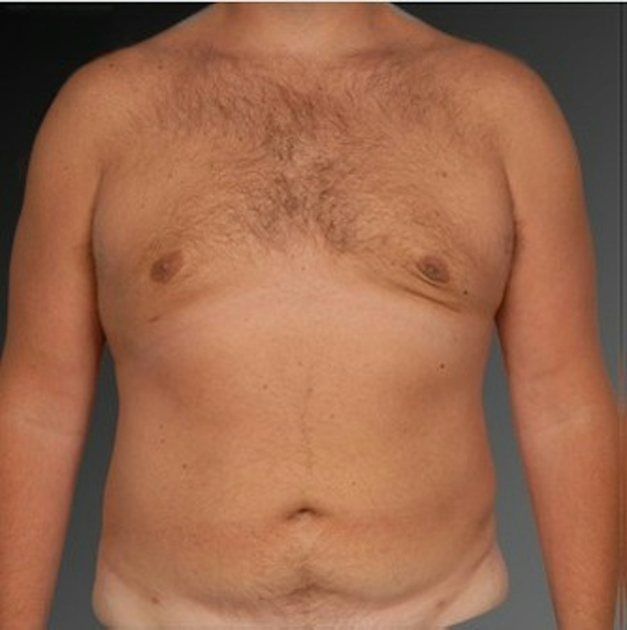 Patient 106041462 | Front View | After | Chest (Gynecomastia) — Steven Teitelbaum MD -