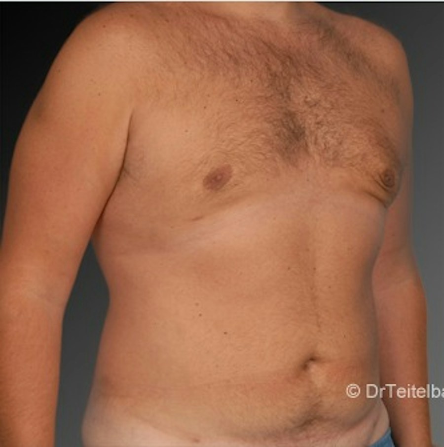 Patient 106041462 | Angle View | After | Chest (Gynecomastia) — Steven Teitelbaum MD -