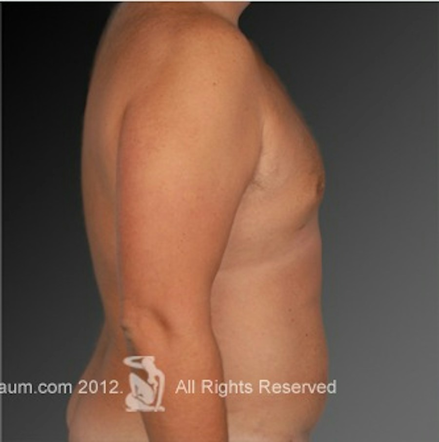 Patient 106041462 | Profile View | After | Chest (Gynecomastia) — Steven Teitelbaum MD -