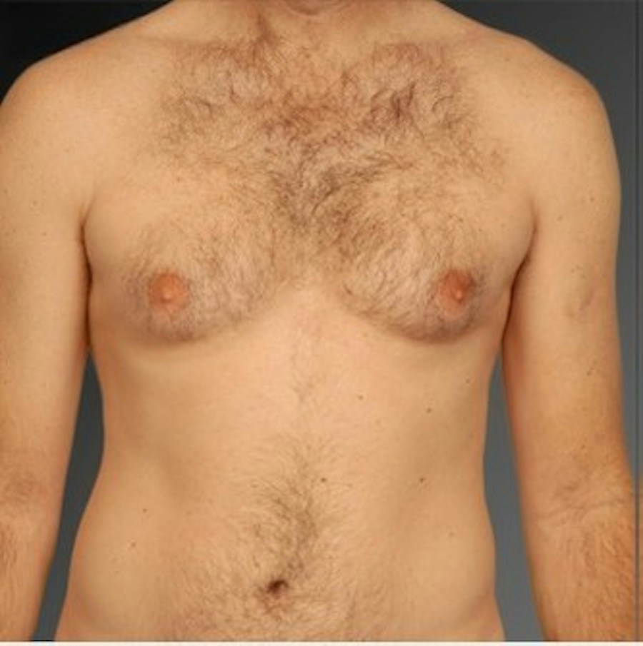 Patient 106041463 | Front View | Before | Chest (Gynecomastia) — Steven Teitelbaum MD -