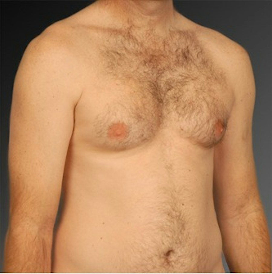 Patient 106041463 | Angle View | Before | Chest (Gynecomastia) — Steven Teitelbaum MD -