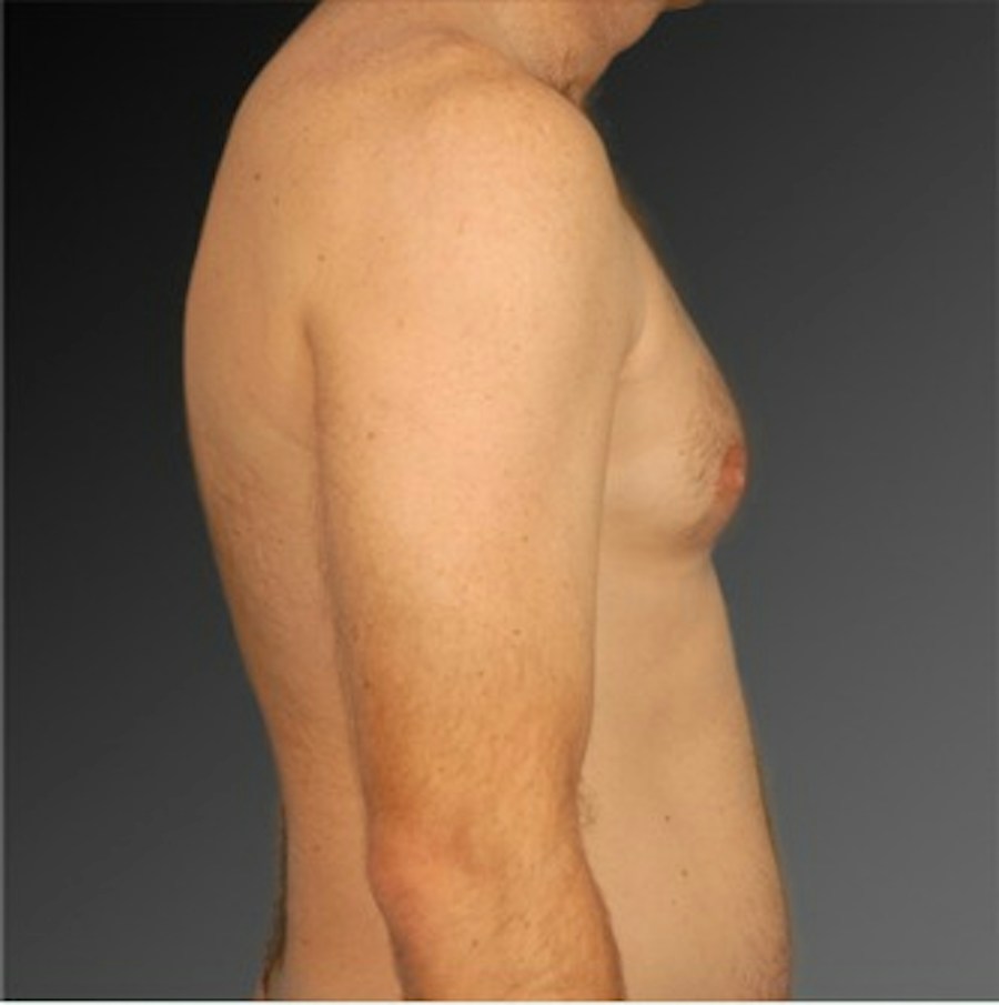 Patient 106041463 | Profile View | Before | Chest (Gynecomastia) — Steven Teitelbaum MD -
