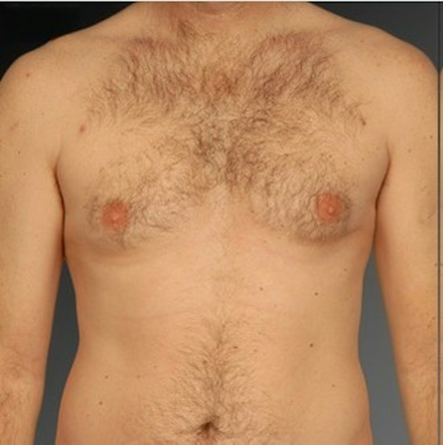 Patient 106041463 | Front View | After | Chest (Gynecomastia) — Steven Teitelbaum MD -