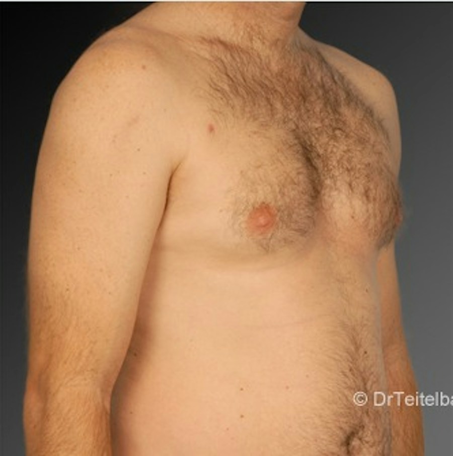 Patient 106041463 | Angle View | After | Chest (Gynecomastia) — Steven Teitelbaum MD -