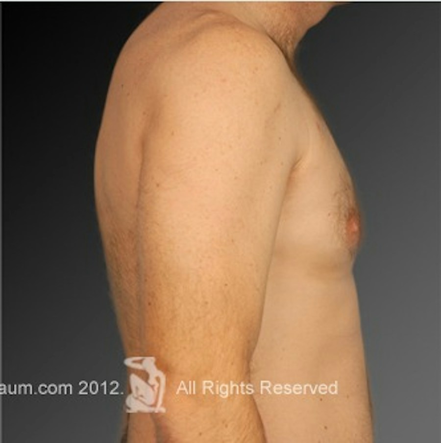 Patient 106041463 | Profile View | After | Chest (Gynecomastia) — Steven Teitelbaum MD -