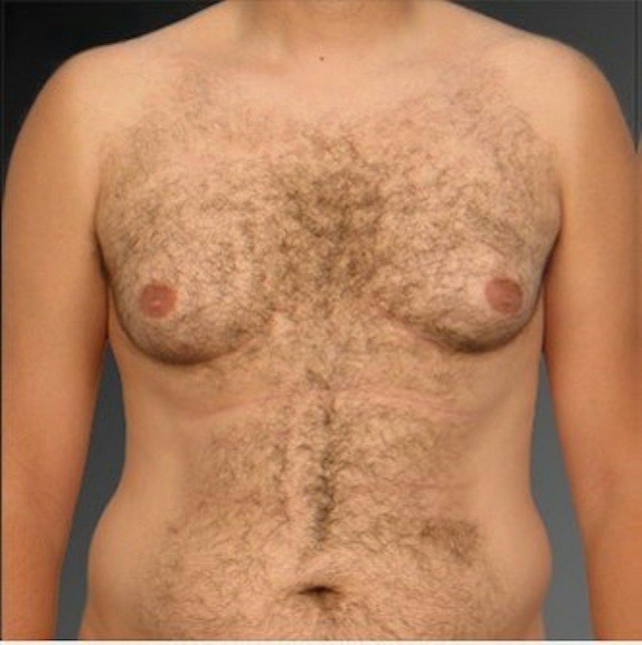 Patient 106041464 | Front View | Before | Chest (Gynecomastia) — Steven Teitelbaum MD -