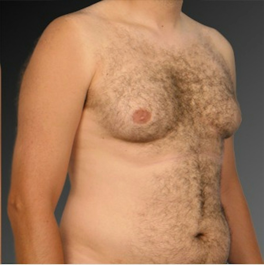Patient 106041464 | Angle View | Before | Chest (Gynecomastia) — Steven Teitelbaum MD -