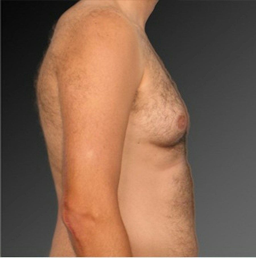 Patient 106041464 | Profile View | Before | Chest (Gynecomastia) — Steven Teitelbaum MD -