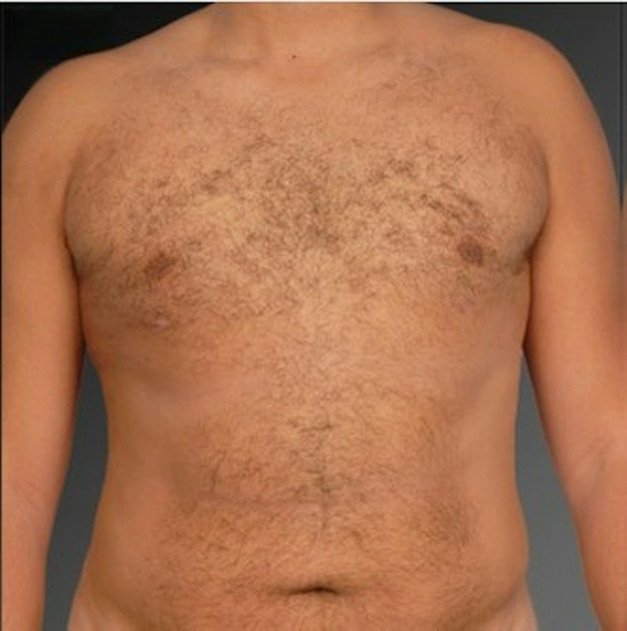 Patient 106041464 | Front View | After | Chest (Gynecomastia) — Steven Teitelbaum MD -