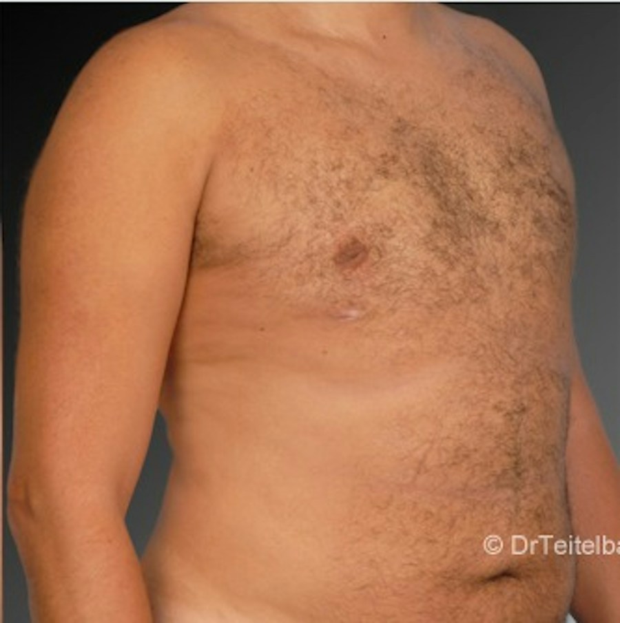 Patient 106041464 | Angle View | After | Chest (Gynecomastia) — Steven Teitelbaum MD -