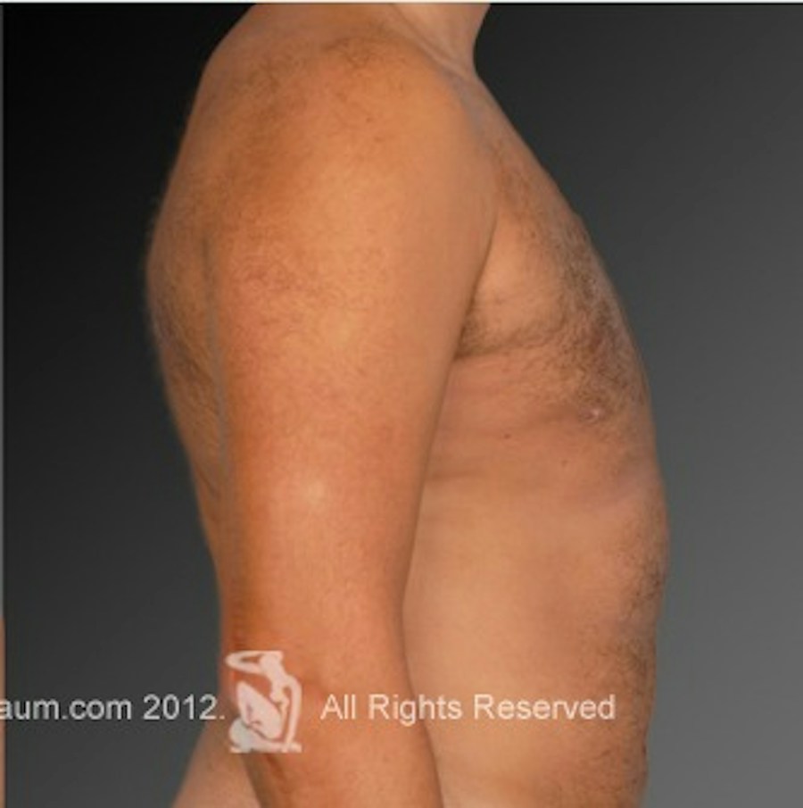 Patient 106041464 | Profile View | After | Chest (Gynecomastia) — Steven Teitelbaum MD -