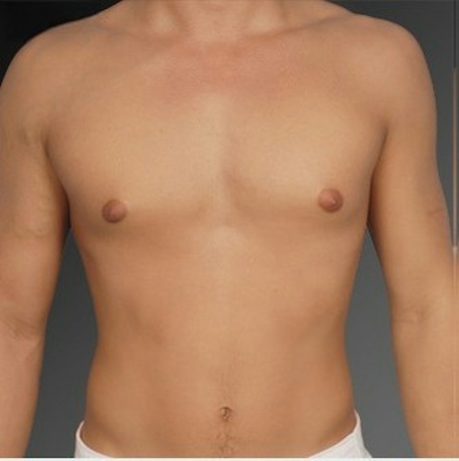 Patient 106041465 | Front View | Before | Chest (Gynecomastia) — Steven Teitelbaum MD -