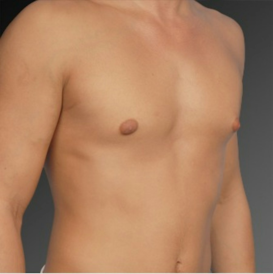 Patient 106041465 | Angle View | Before | Chest (Gynecomastia) — Steven Teitelbaum MD -