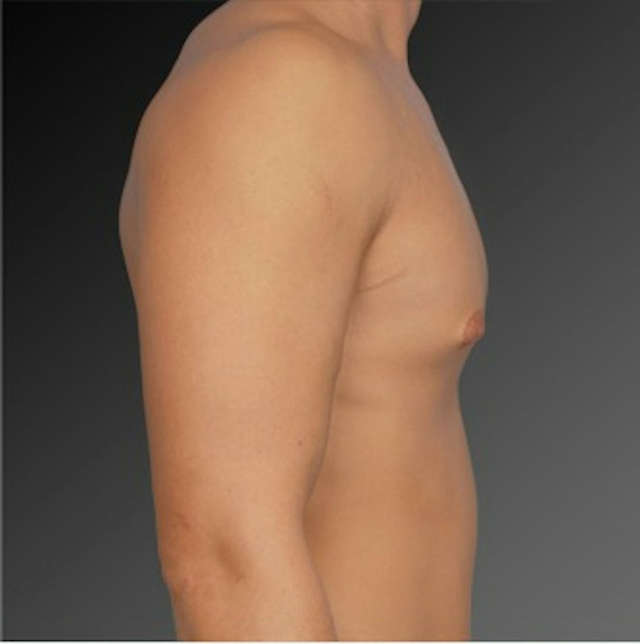 Patient 106041465 | Profile View | Before | Chest (Gynecomastia) — Steven Teitelbaum MD -
