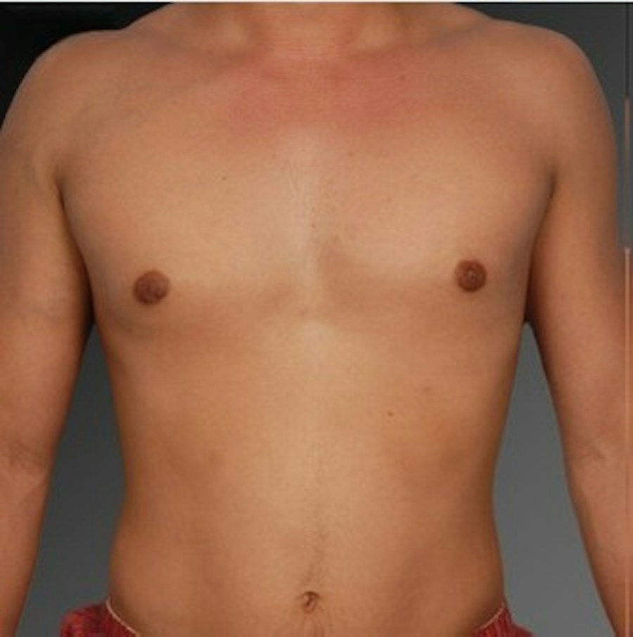 Patient 106041465 | Front View | After | Chest (Gynecomastia) — Steven Teitelbaum MD -
