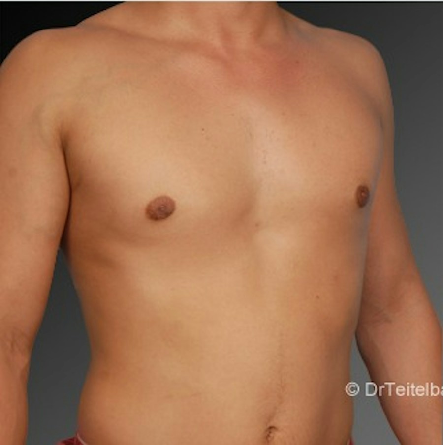 Patient 106041465 | Angle View | After | Chest (Gynecomastia) — Steven Teitelbaum MD -