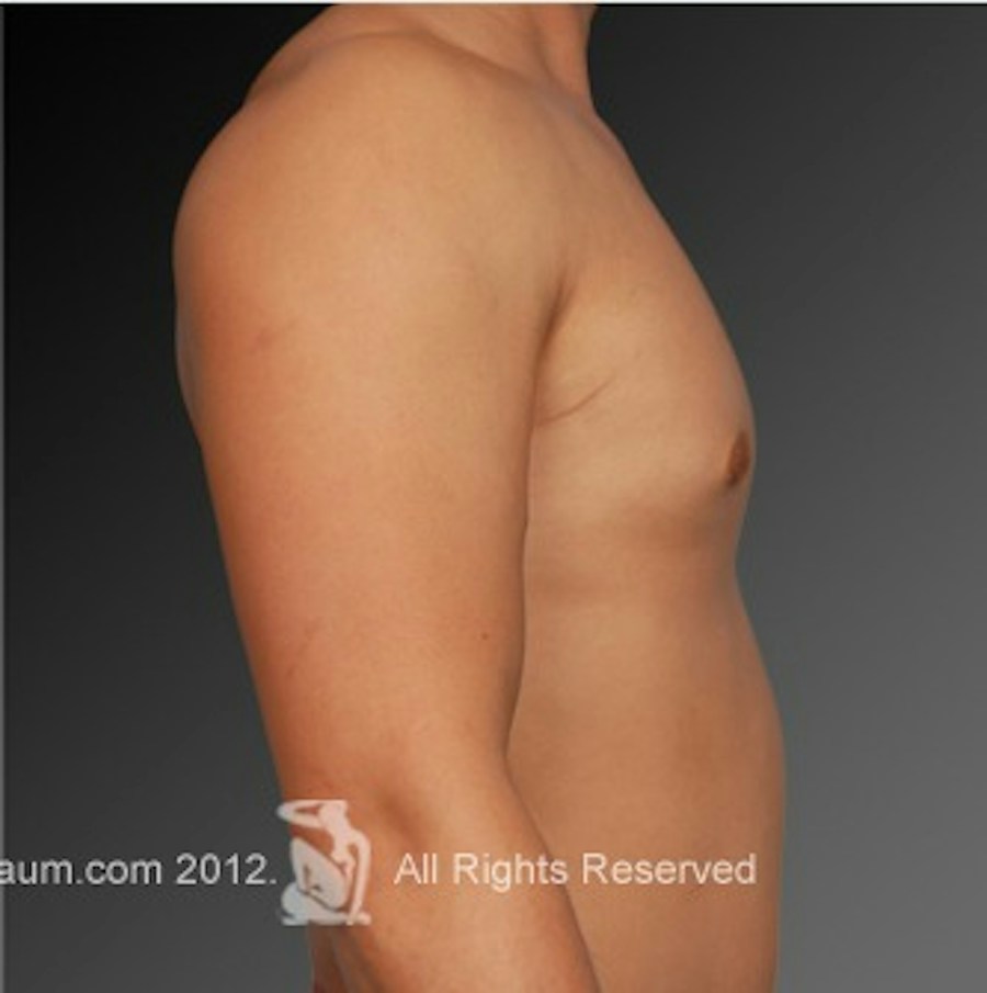 Patient 106041465 | Profile View | After | Chest (Gynecomastia) — Steven Teitelbaum MD -