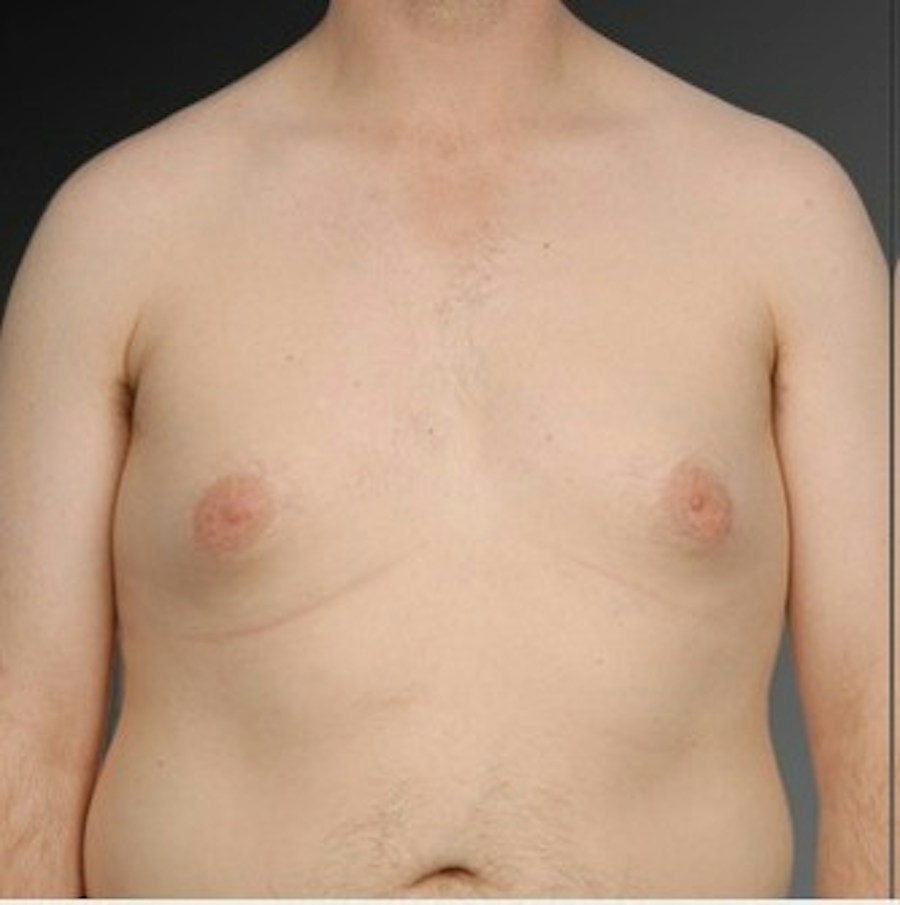 Patient 106041467 | Front View | Before | Chest (Gynecomastia) — Steven Teitelbaum MD -