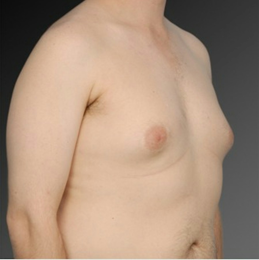 Patient 106041467 | Angle View | Before | Chest (Gynecomastia) — Steven Teitelbaum MD -