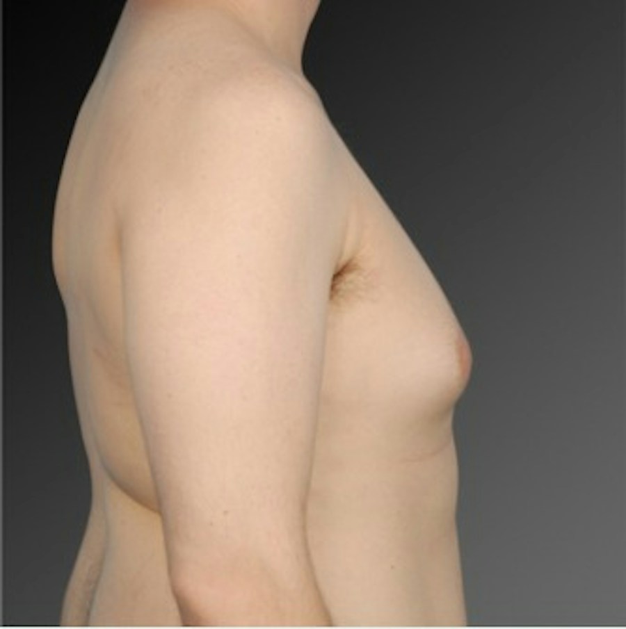 Patient 106041467 | Profile View | Before | Chest (Gynecomastia) — Steven Teitelbaum MD -