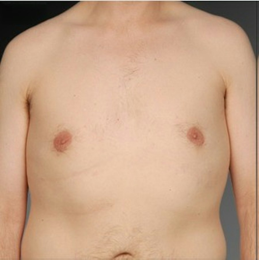 Patient 106041467 | Front View | After | Chest (Gynecomastia) — Steven Teitelbaum MD -