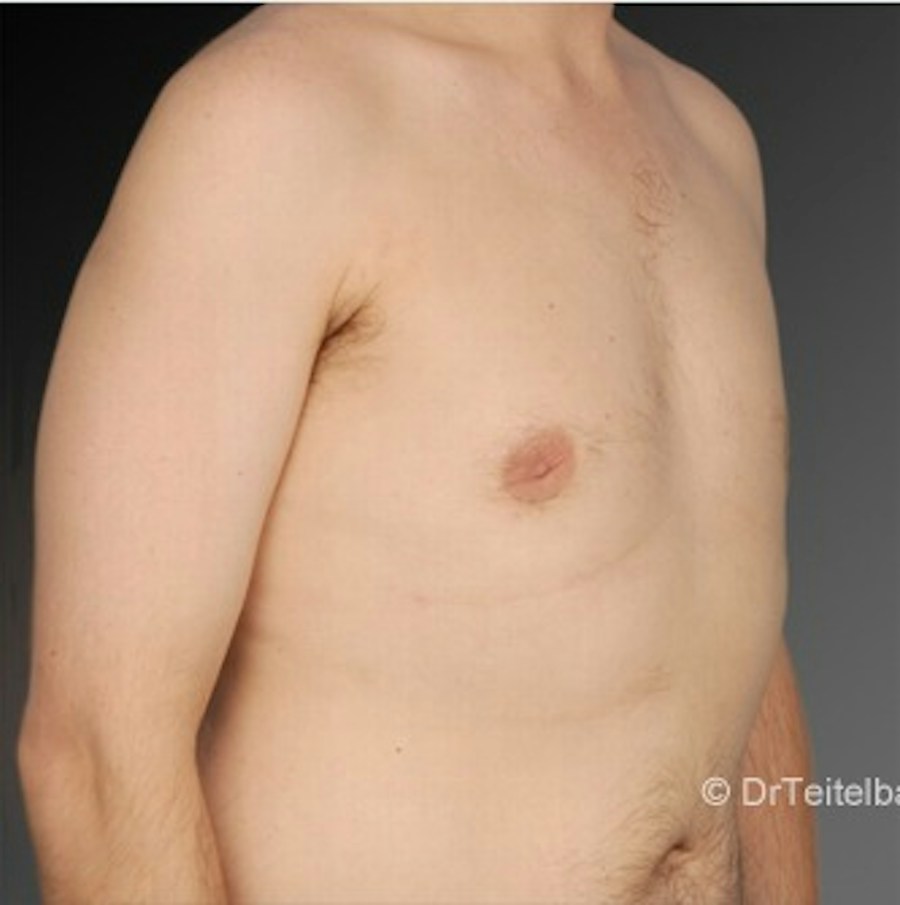 Patient 106041467 | Angle View | After | Chest (Gynecomastia) — Steven Teitelbaum MD -