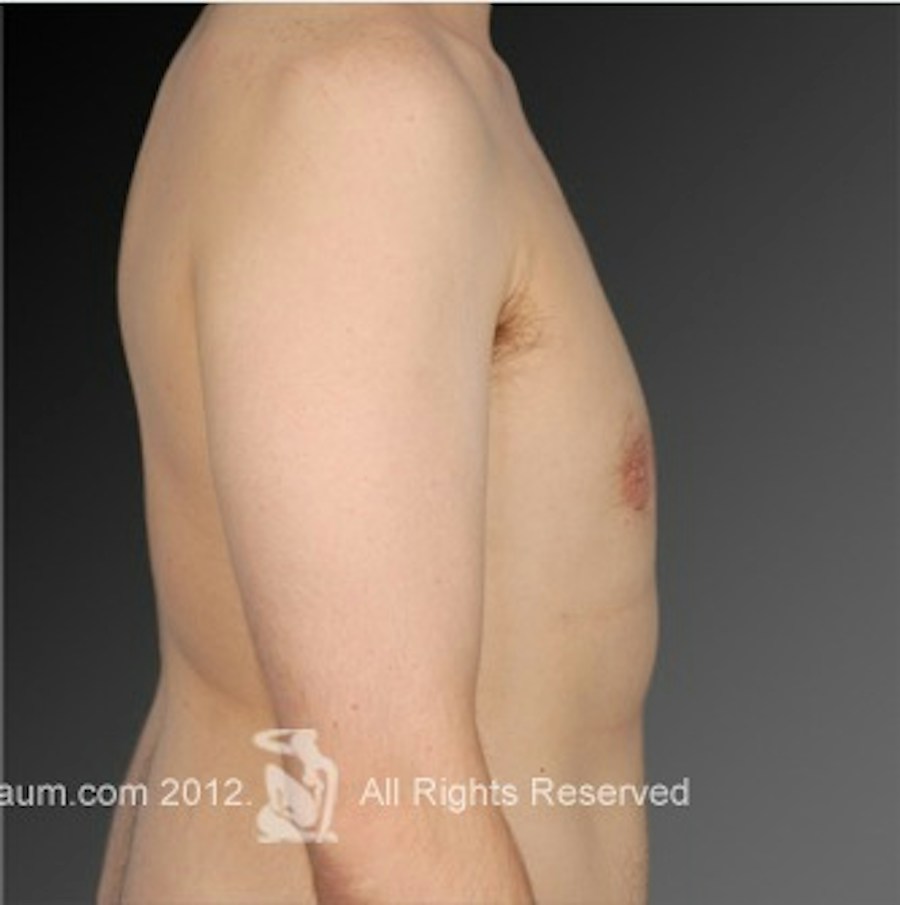 Patient 106041467 | Profile View | After | Chest (Gynecomastia) — Steven Teitelbaum MD -