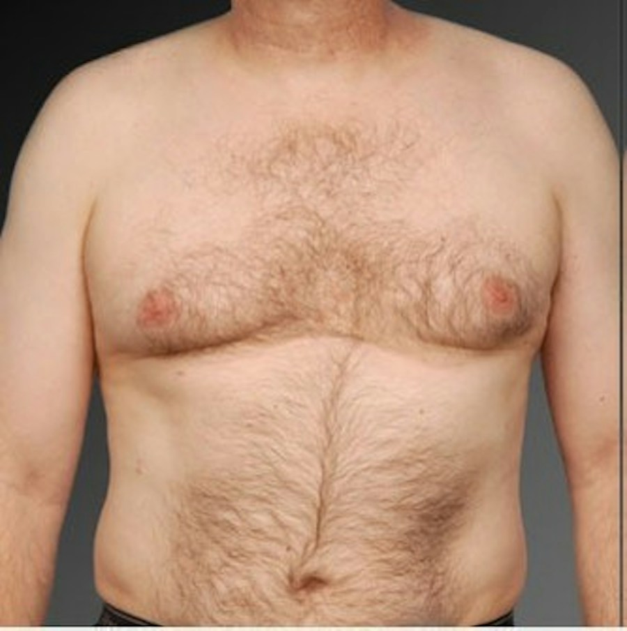 Patient 106041468 | Front View | Before | Chest (Gynecomastia) — Steven Teitelbaum MD -