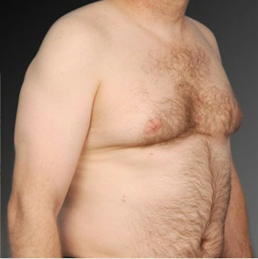 Patient 106041468 | Angle View | Before | Chest (Gynecomastia) — Steven Teitelbaum MD -