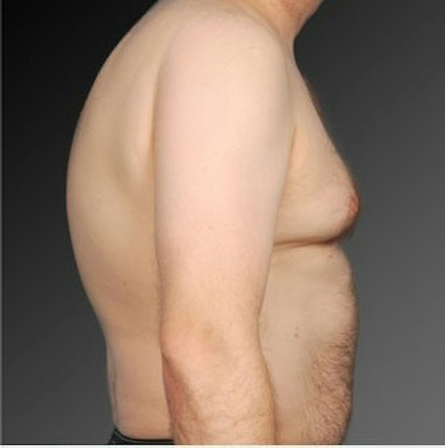 Patient 106041468 | Profile View | Before | Chest (Gynecomastia) — Steven Teitelbaum MD -