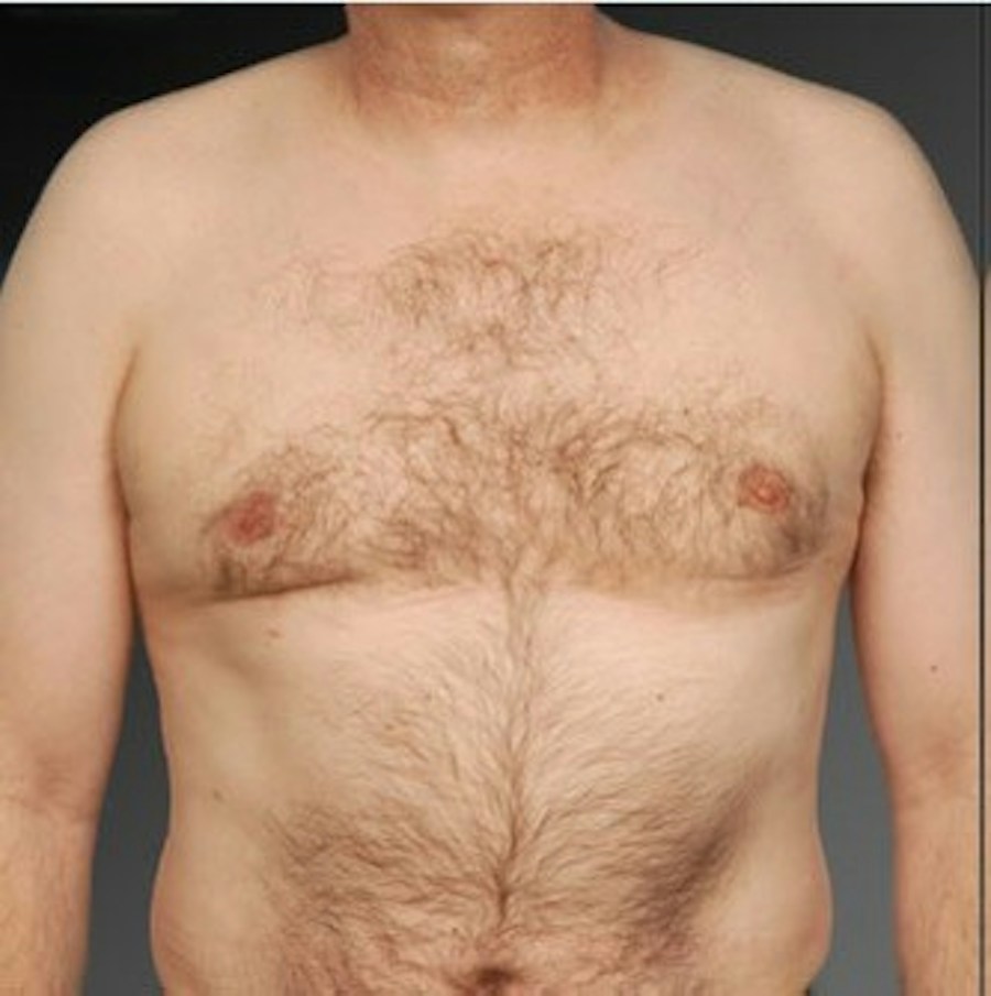 Patient 106041468 | Front View | After | Chest (Gynecomastia) — Steven Teitelbaum MD -