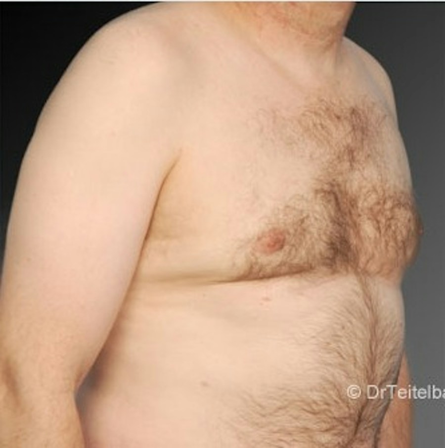 Patient 106041468 | Angle View | After | Chest (Gynecomastia) — Steven Teitelbaum MD -