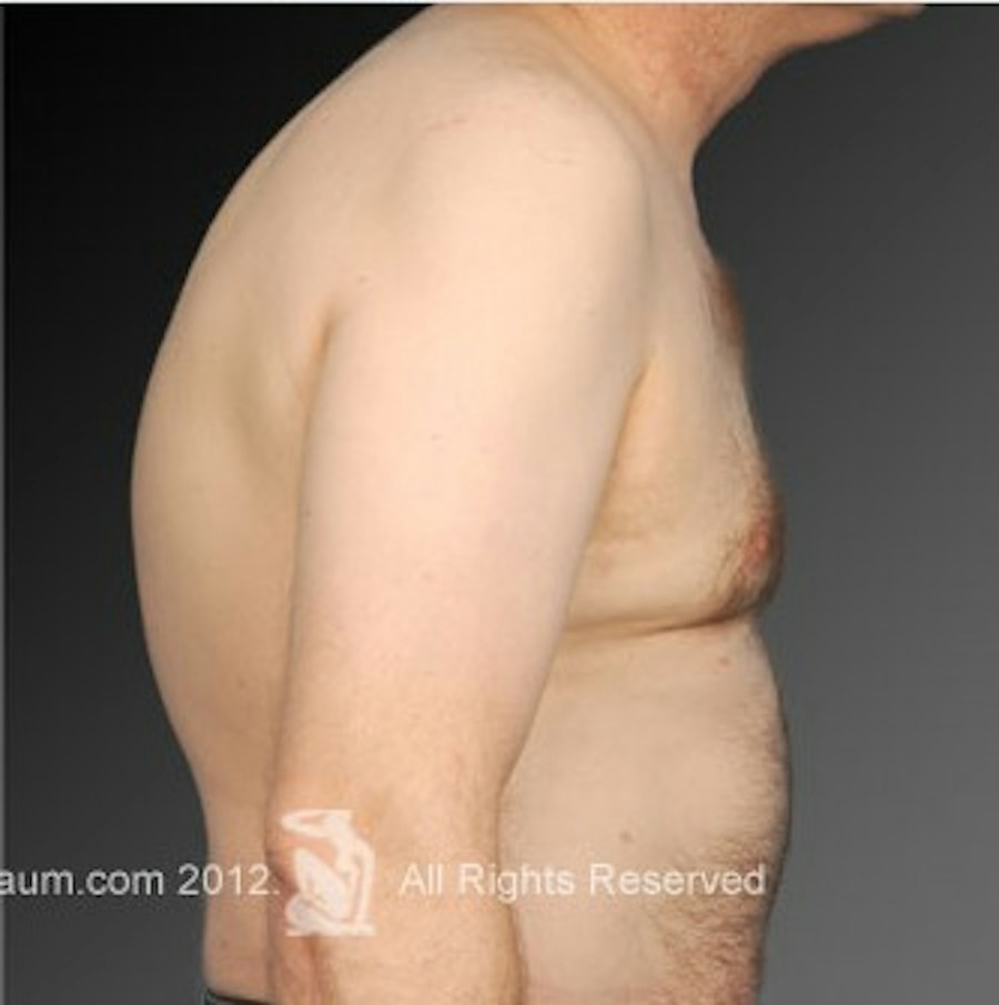 Patient 106041468 | Profile View | After | Chest (Gynecomastia) — Steven Teitelbaum MD -