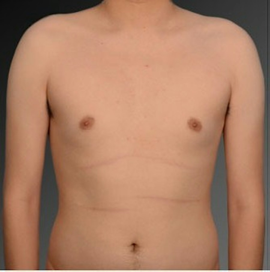 Patient 106041472 | Front View | Before | Chest (Gynecomastia) — Steven Teitelbaum MD -