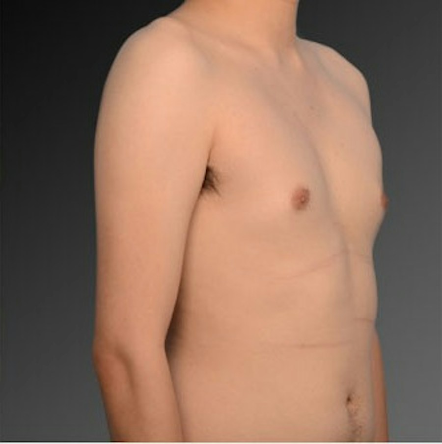 Patient 106041472 | Angle View | Before | Chest (Gynecomastia) — Steven Teitelbaum MD -