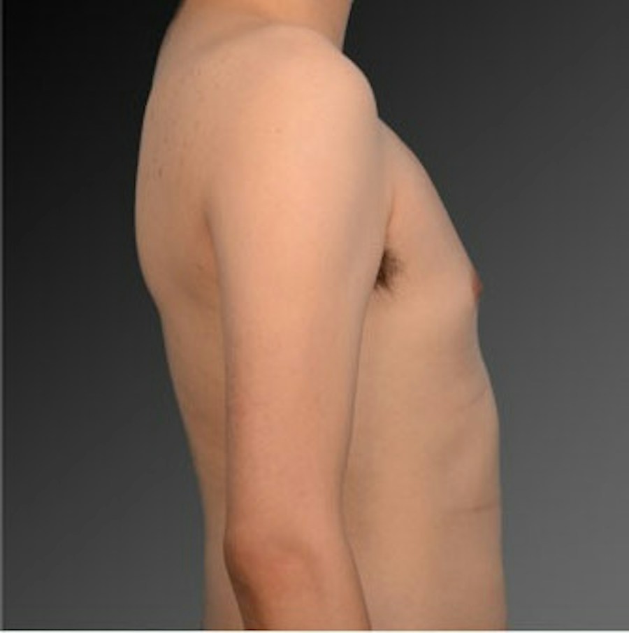 Patient 106041472 | Profile View | Before | Chest (Gynecomastia) — Steven Teitelbaum MD -