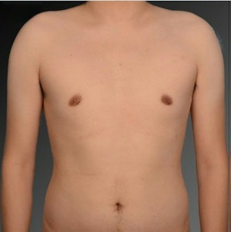 Patient 106041472 | Front View | After | Chest (Gynecomastia) — Steven Teitelbaum MD -